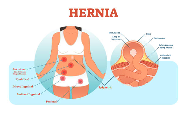 Hernia Cause